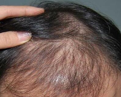脱发有哪些常见病因?太和脱发医院